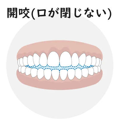 開咬（口が閉じない）