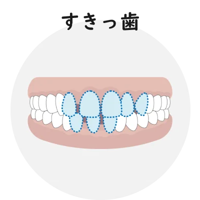 すきっ歯