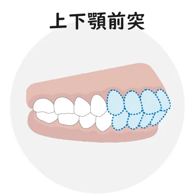 上下顎前突
