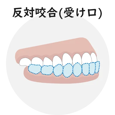 反対開咬（受け口）