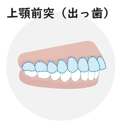 上顎前突（出っ歯）