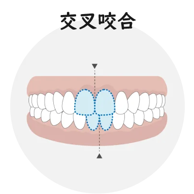 交叉咬合